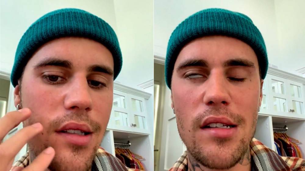 Justin Bieber felç geçirdi