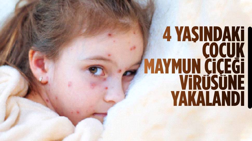 4 yaşındaki çocuğa maymun çiçeği virüsü bulaştı