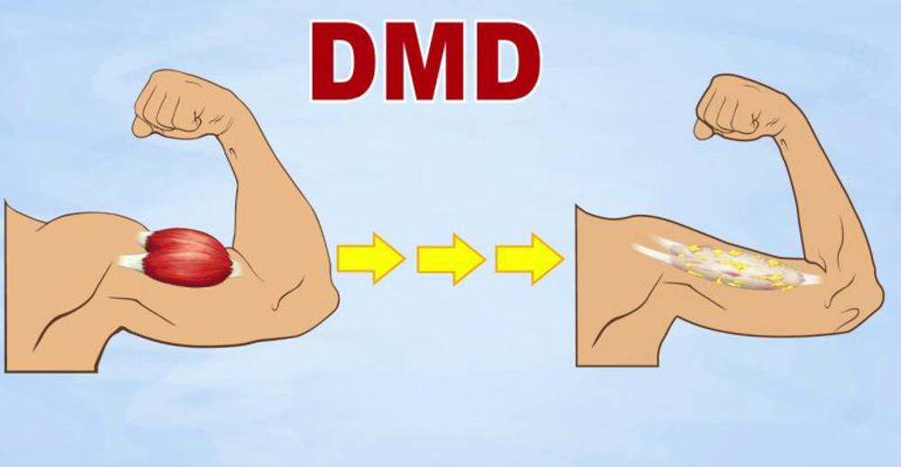 DMD Kas Hastalığı nedir?