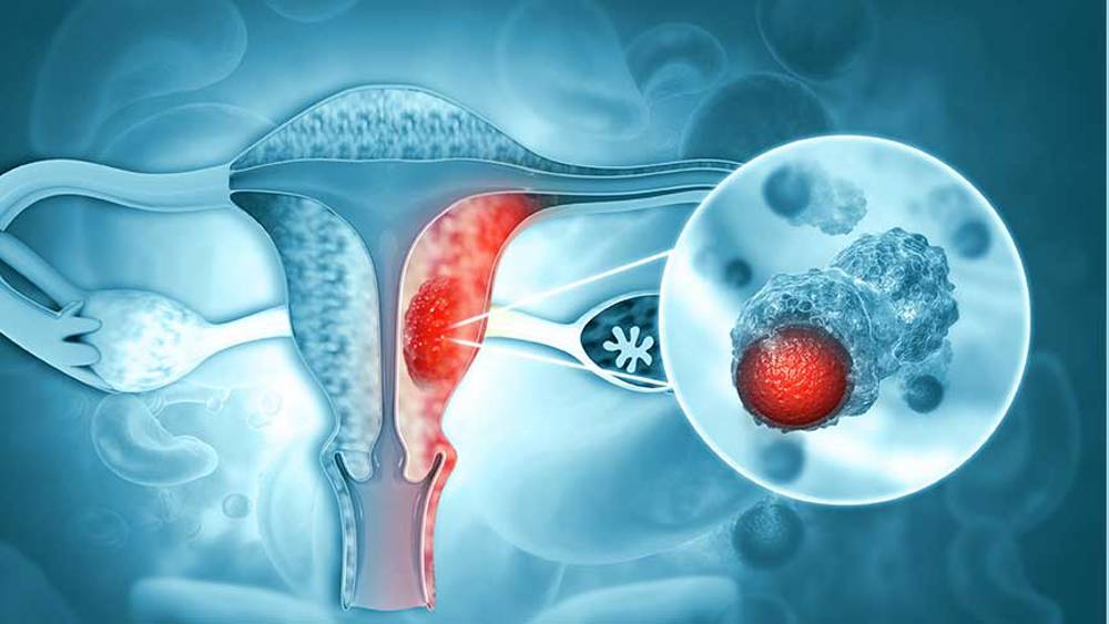 Proliferatif endometrium nedir?