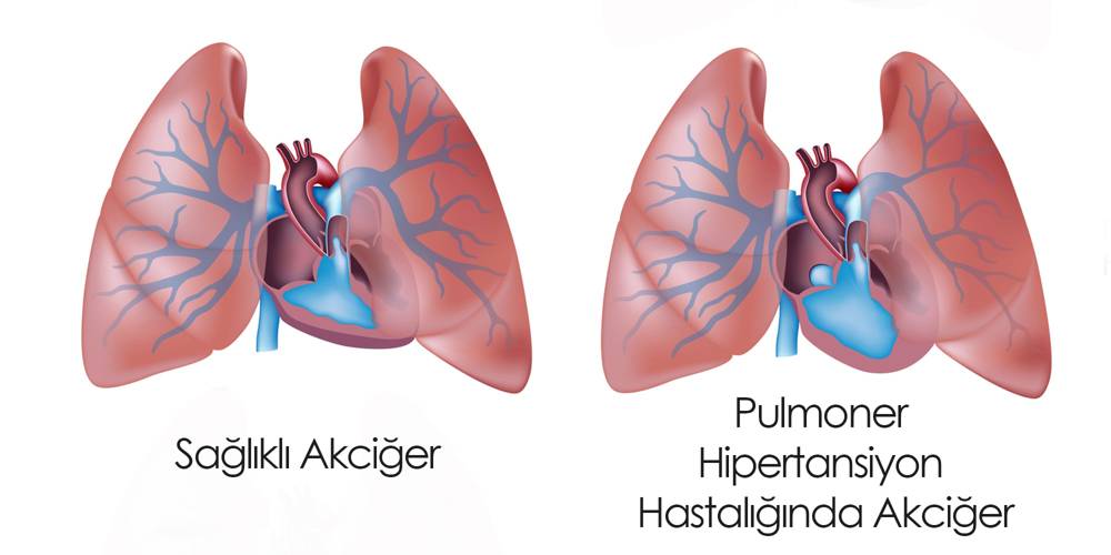 Pulmoner hipertansiyon nedir?