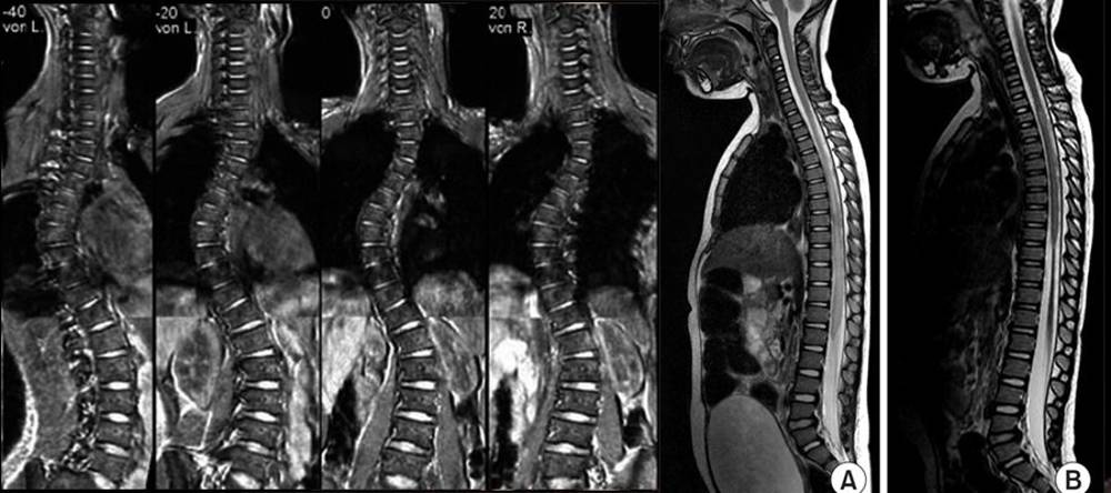 Lomber Vertebra Kontrastsız Nedir Ankara Masası