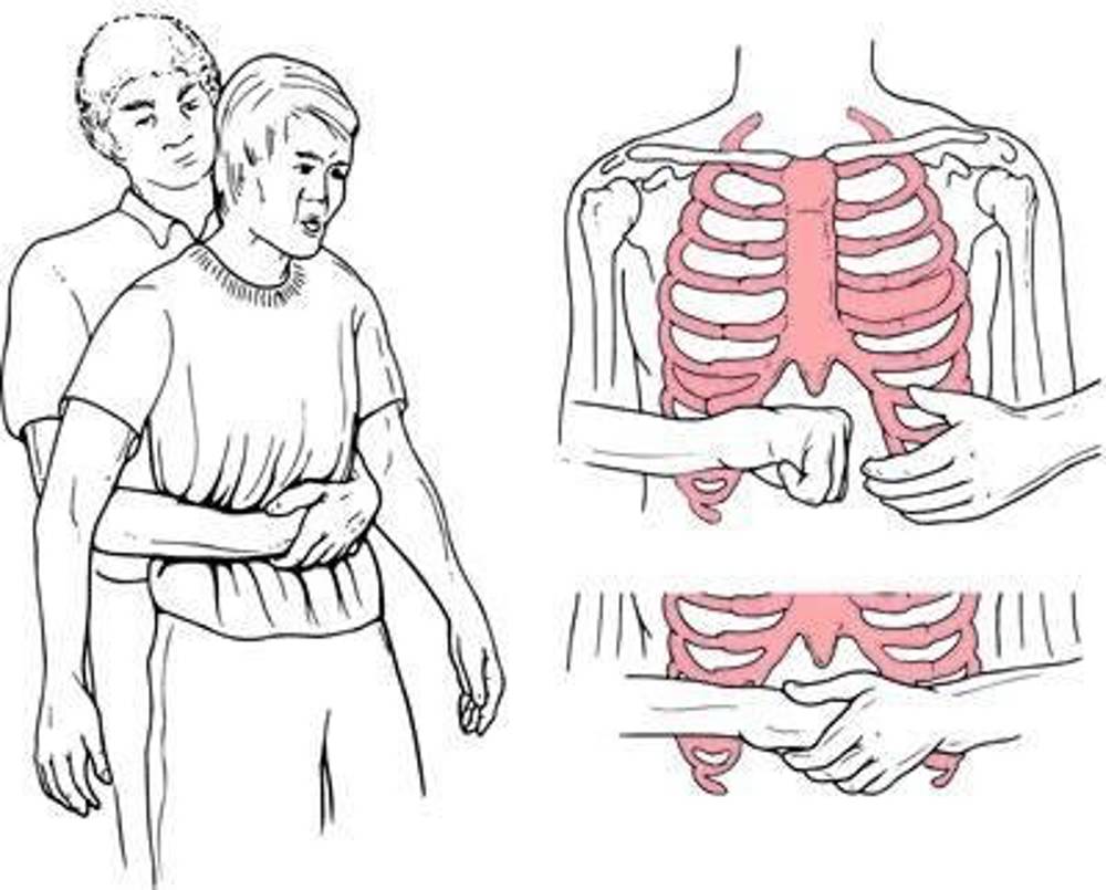 Heimlich manevrası nedir? Nasıl yapılır?