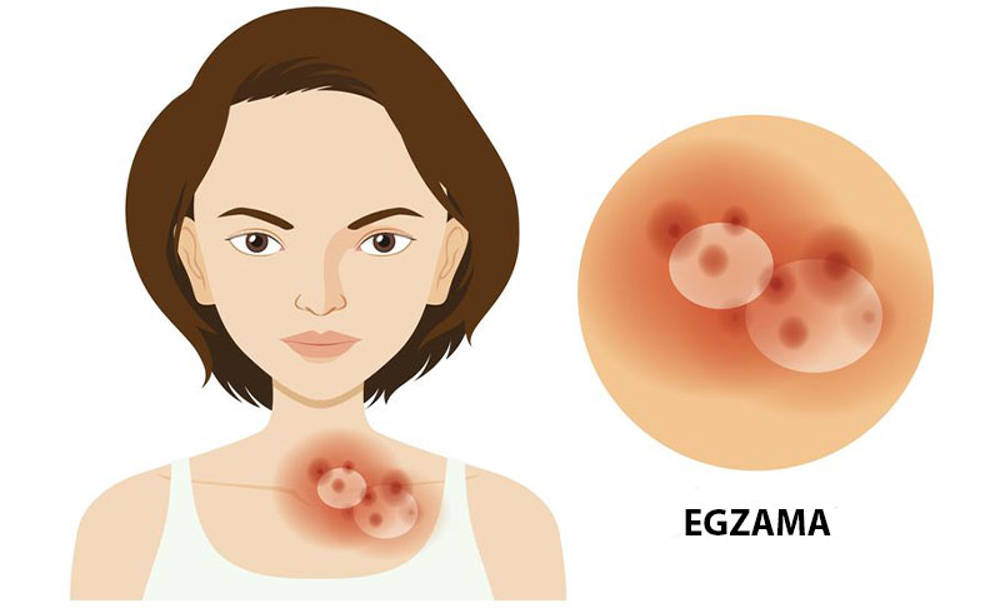 Egzama nedir? 