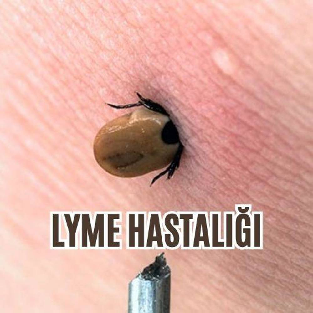 Lyme hastalığı nedir? 