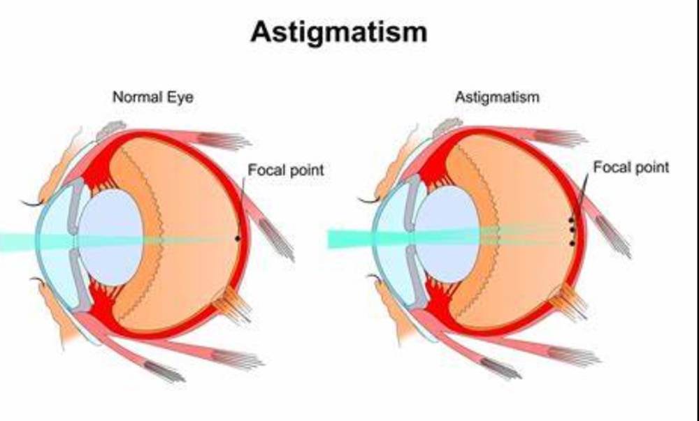 Astigmat Nedir?