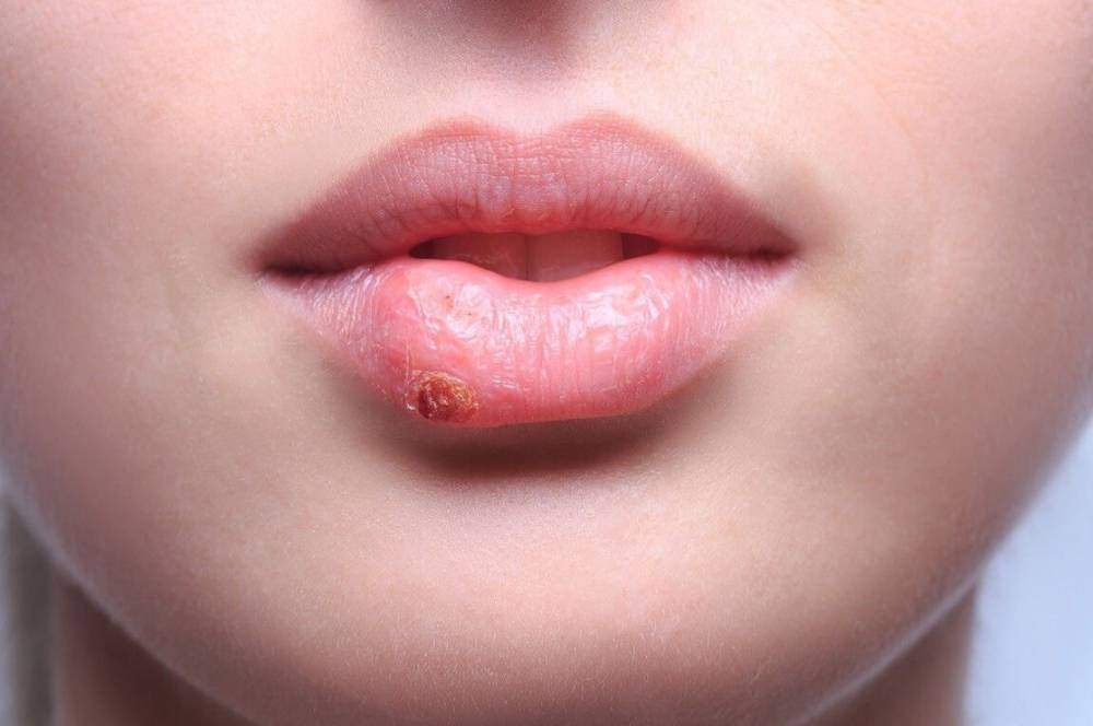 Herpes virüsü nedir, belirtileri ve tedavi yöntemleri nelerdir?