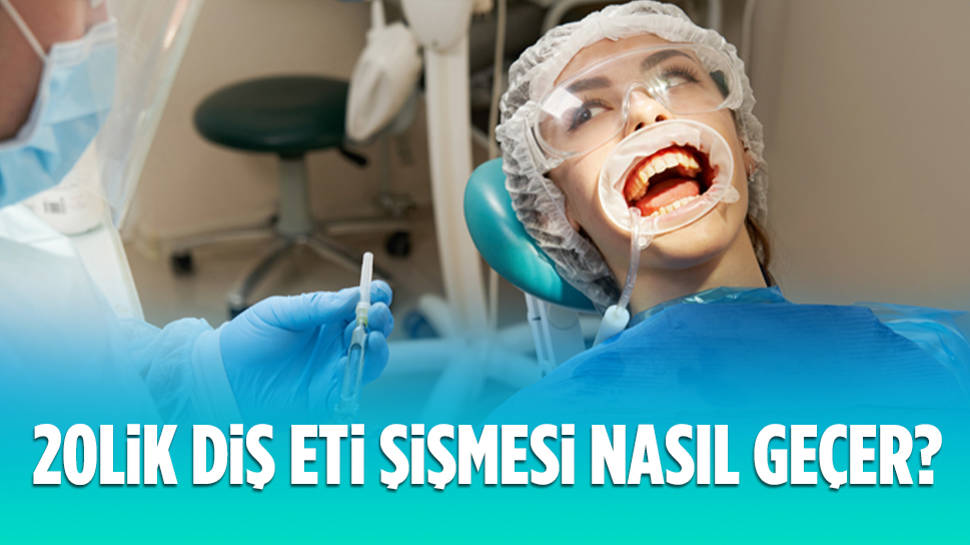 20'lik diş eti şişmesi nasıl geçer?