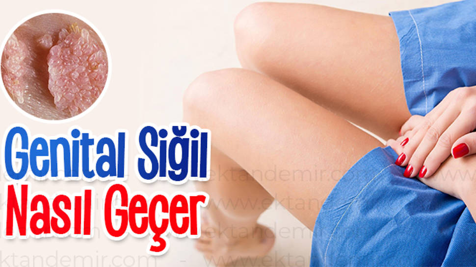 Genital bölgede siğil nasıl geçer ? Nasıl tedavi edilir?