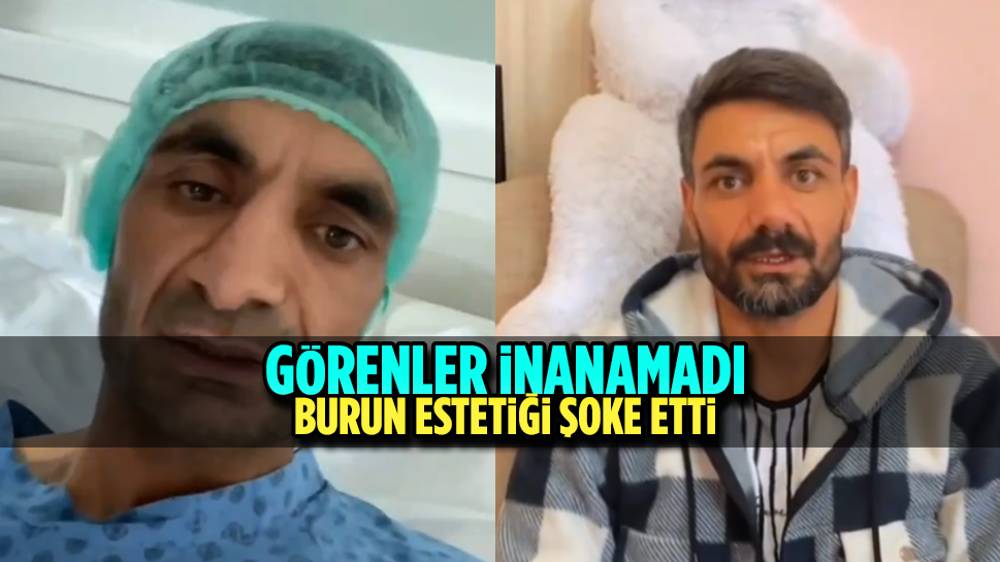 Burun estetiği öncesi ve sonrasını paylaşan kişinin yüzündeki değişim görenleri şok etti