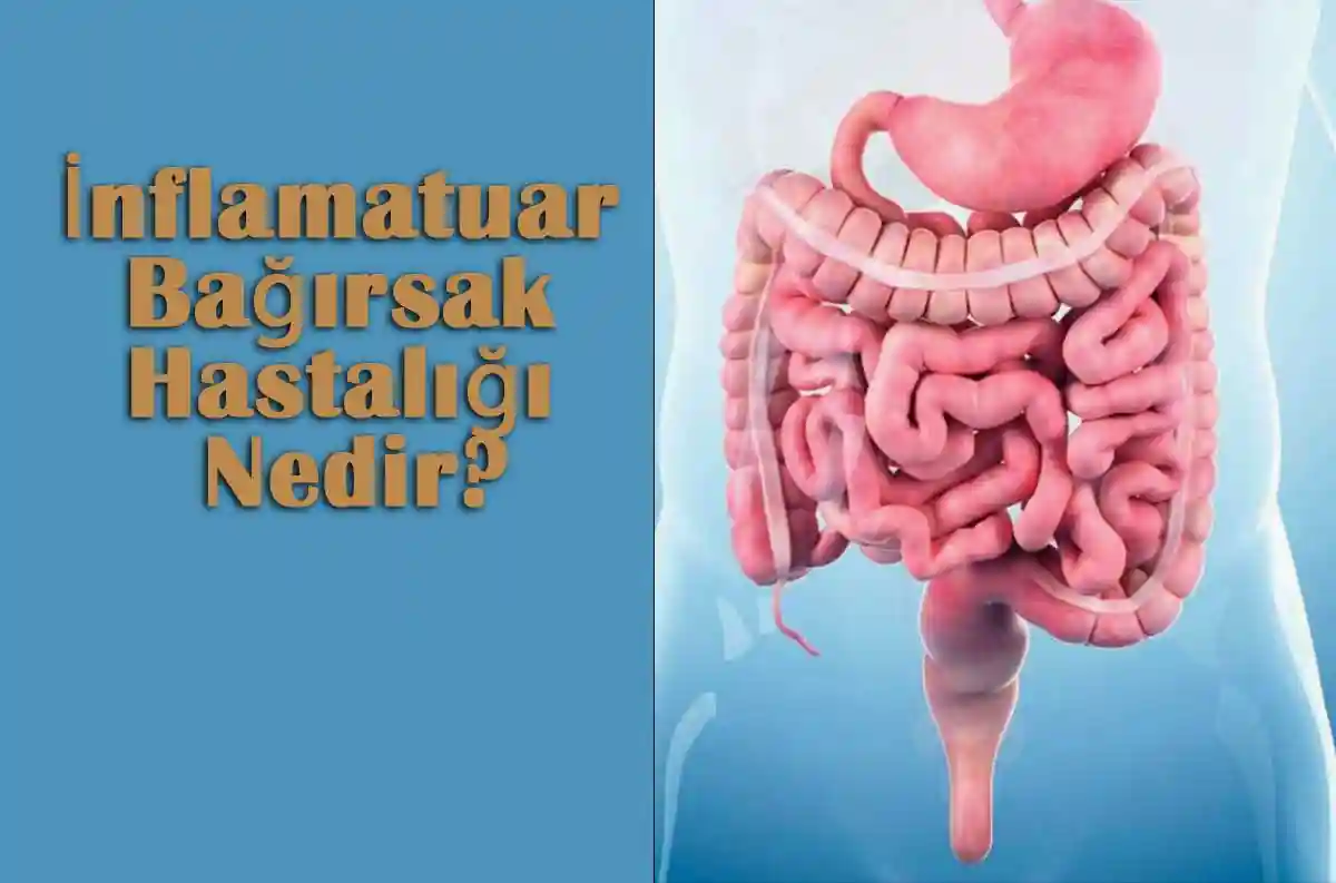 İnflamatuar Bağırsak Hastalığı Nedir?