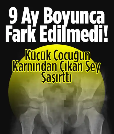 5 yaşındaki çocuğun 9 ay önce yuttuğu toplu iğne çıkarıldı