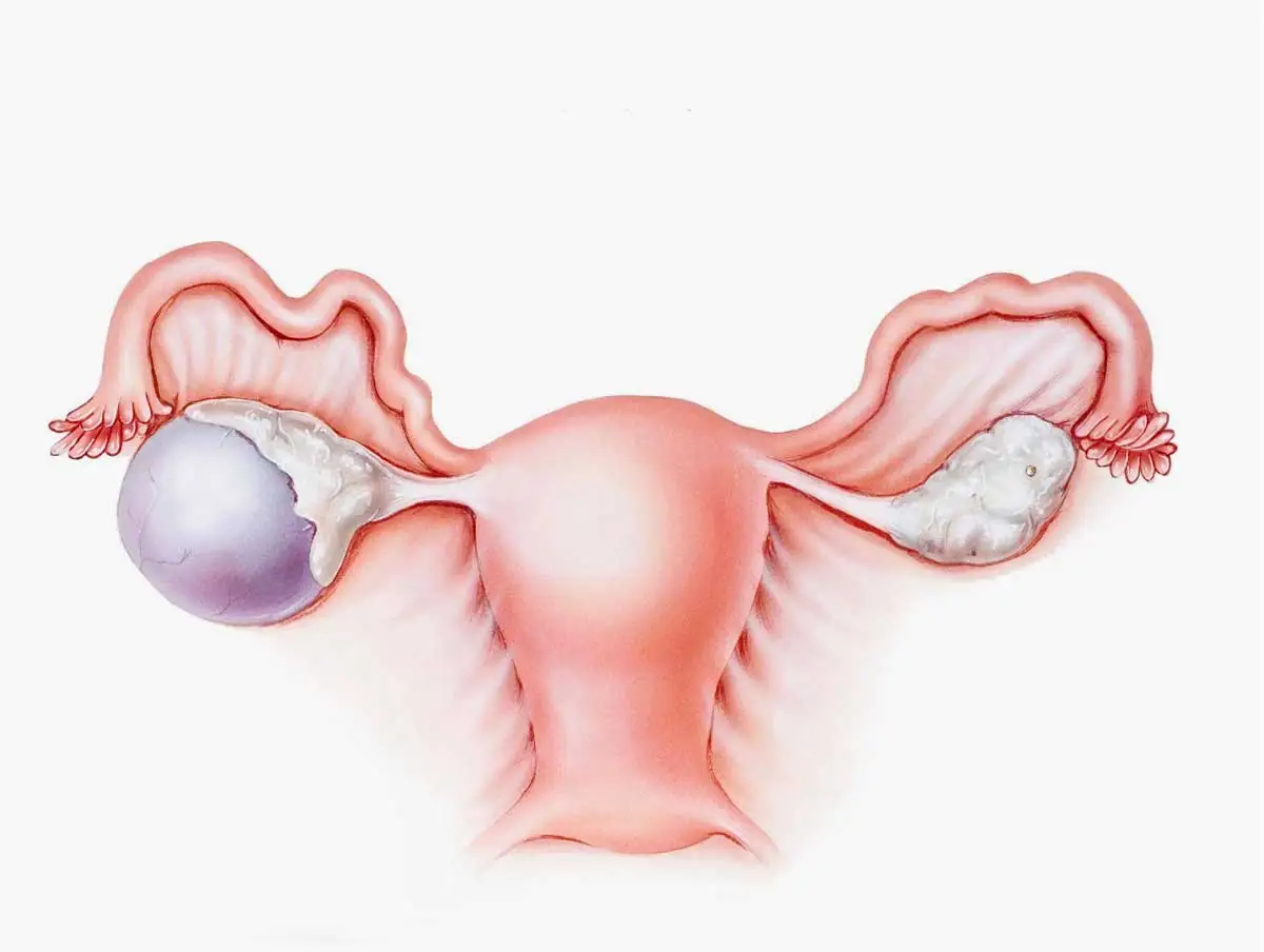 Yumurtalık Kisti Nedir?