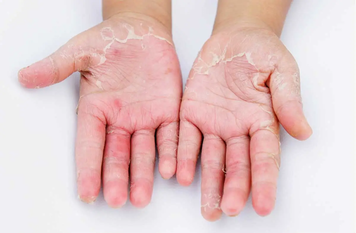 Kontakt Dermatit Nedir?