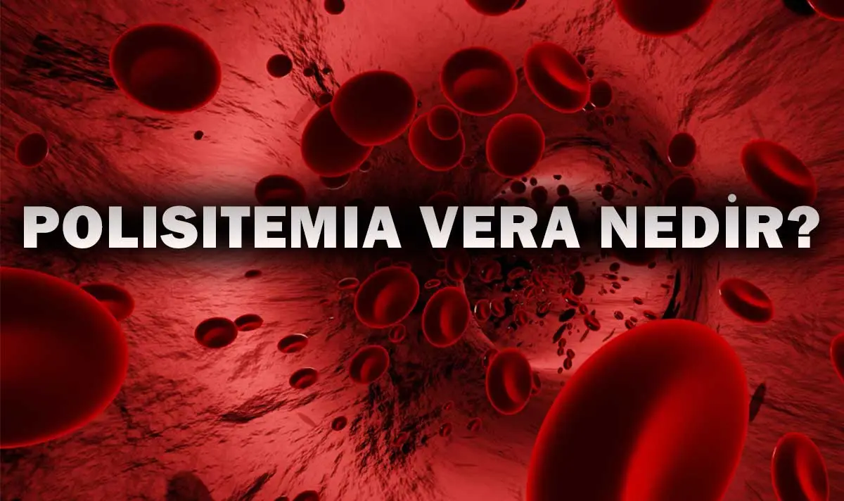 Polisitemia Vera Nedir?